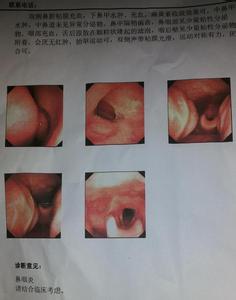 鼻咽炎 鼻咽炎-病症病因，鼻咽炎-检查诊断