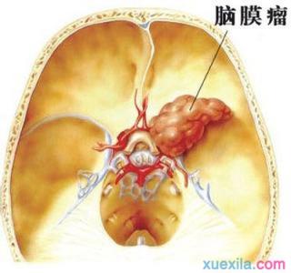 脑膜瘤 脑膜瘤-疾病分类，脑膜瘤-发病原因