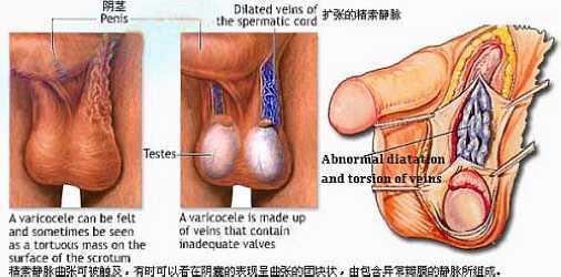 男性精索静脉曲张 男性精索静脉曲张-早期识别，男性精索静脉曲张