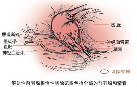 前列腺癌分类 前列腺癌 前列腺癌-概述，前列腺癌-分类