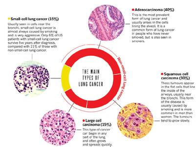 肺癌的分类和分型 肺癌 肺癌-简介，肺癌-分类