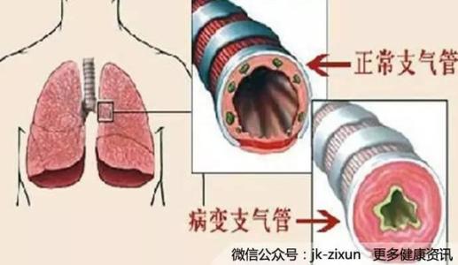 慢性支气管炎临床表现 支气管炎 支气管炎-疾病原因，支气管炎-临床表现