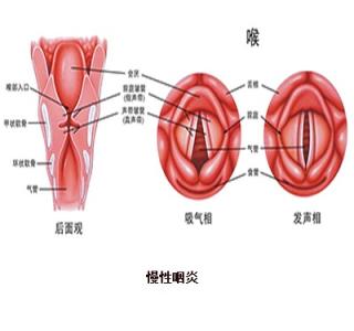 慢性咽炎病因 慢性咽炎 慢性咽炎-分类，慢性咽炎-病因