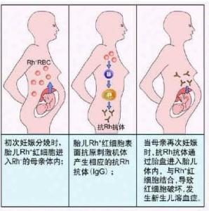 溶血症 溶血症-病因和发病机制，溶血症-分类