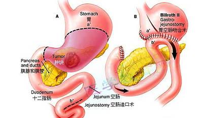 流行病学病因 十二指肠旁疝 十二指肠旁疝-流行病学，十二指肠旁疝-病因