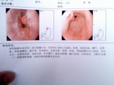 十二指肠息肉 十二指肠息肉-疾病描述，十二指肠息肉-症状体征