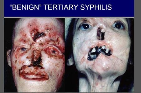 梅毒 syphilis