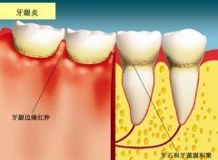 牙龈炎可以自愈吗 牙龈炎怎么办