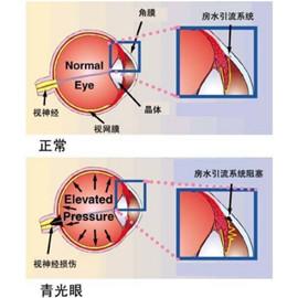 青光眼有哪些症状 青光眼有哪些危害