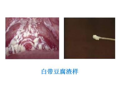 为什么白带豆腐渣状 白带为什么是豆腐渣状