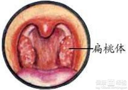 扁桃体肿大是什么原因 扁桃体肿大的原因及危害是什么