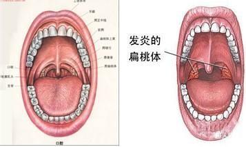 是什么导致扁桃体发炎 扁桃体发炎是什么引起的