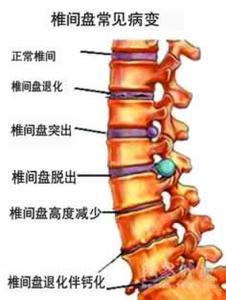 女性腰椎间盘突出症状 腰椎间盘突出症的症状