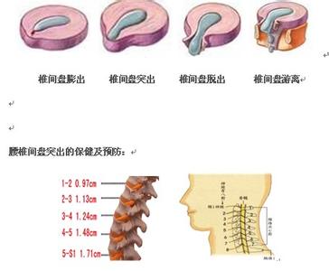 腰椎间盘突出日常护理 腰椎间盘突出日常护理方法