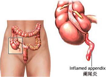 阑尾炎早期症状 阑尾炎有哪些早期症状？