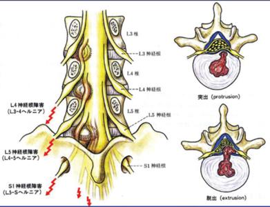 腰椎间盘突出症的疗法 腰椎间盘突出症的拔罐疗法