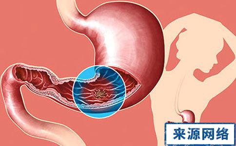 胃溃疡出血 胃溃疡出血急救原则