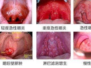 民间治疗头皮屑小偏方 民间治疗咽喉炎的小偏方