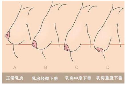 产后胸下垂多久恢复 产后胸部下垂怎么办