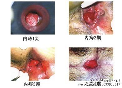 痔疮患者不能吃什么? 痔疮患者不能吃什么