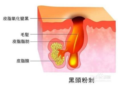 如何有效去除黑头粉刺 如何有效的去除黑头呢