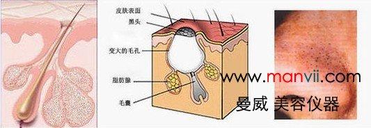 黑头是怎么形成的图解 黑头是如何形成的