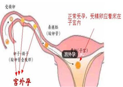 宫外孕做了后还能生吗 宫外孕还能生孩子吗