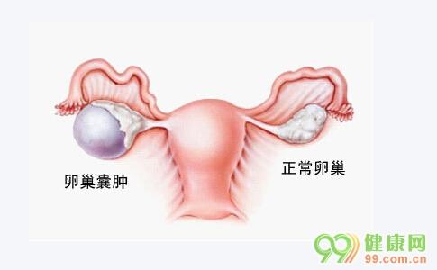 卵巢囊肿影响怀孕吗 卵巢囊肿会影响生育吗