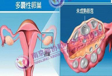 卵泡大不排是什么原因 卵巢不排卵是什么原因