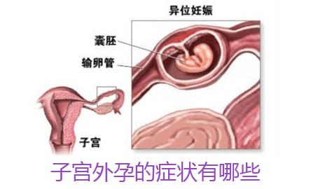 如何判断宫外孕 怎么样判断宫外孕？