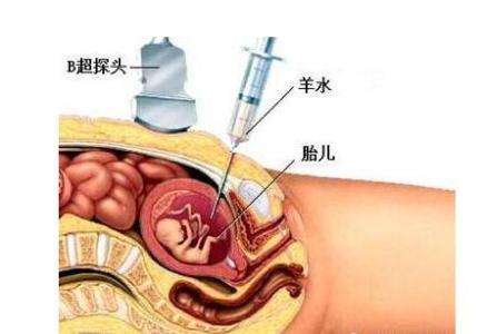 羊水早破的原因 羊水早破的原因和4大危害