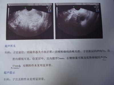 怀孕空孕囊有什么征兆 空孕囊会有早孕反应吗