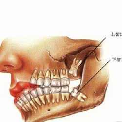 智齿包在肉里面图片 古代人长智齿怎么办