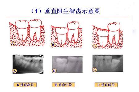 长智齿会影响脸型吗 什么是智齿_长智齿会有什么影响