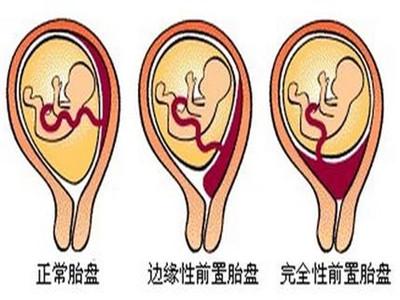 前壁和后壁哪个容易生 胎盘前壁和后壁的区别