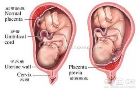 前置胎盘如何治疗 前置胎盘该如何治疗