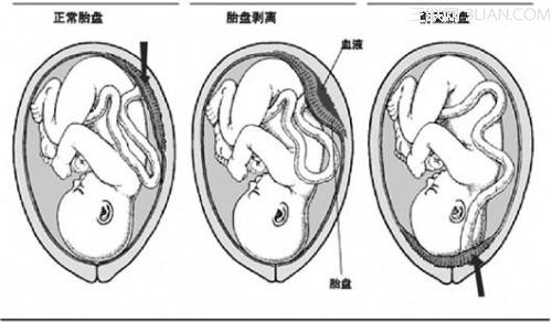 前置胎盘 前置胎盘有几种情况