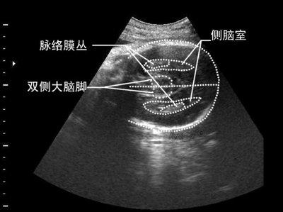 39周胎儿双顶径标准 39周胎儿双顶径偏大怎么办