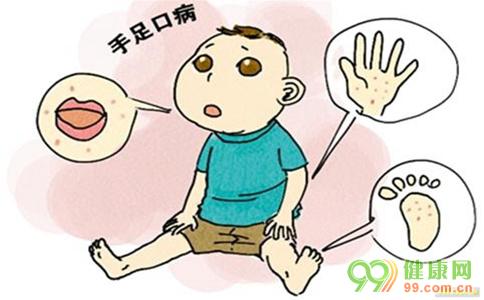 宝宝手足口病预防 宝宝该如何预防手足口病