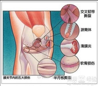 膝关节扭伤的处理方法 膝关节扭伤了怎么样应急处理