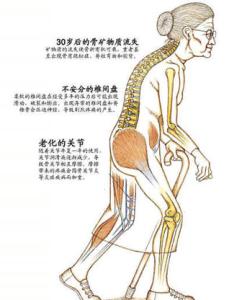 如何预防骨质疏松 上班族如何预防骨质疏松