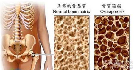 骨质疏松吃什么钙片 骨质疏松吃什么好