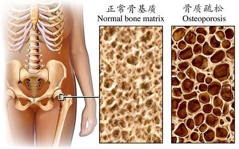 骨质疏松应该补什么 骨质疏松要补什么呢