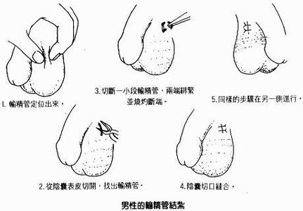 国外女性常用避孕方式 男人常用的避孕方式