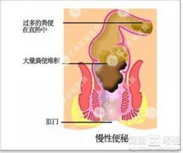 手术后便秘吃什么好 手术后便秘怎么办