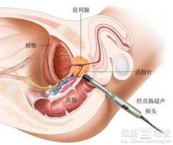 前列腺癌 维e长期吃会患上前列腺癌？