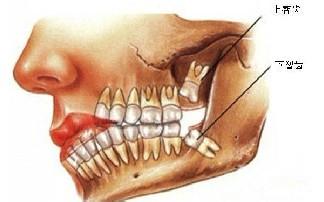 拔牙对身体有什么影响 拔牙的危害