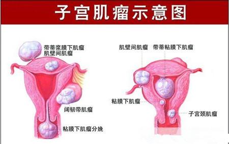 子宫肌瘤吃什么药消除 子宫肌瘤不能吃什么