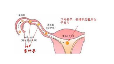 跳绳可以预防宫外孕吗 宫外孕能预防吗