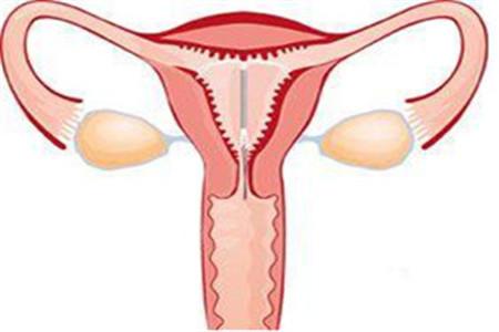 上环手术流程图 上环疼吗